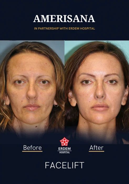 Facelift before and after, in partnership with Erdem Hospital