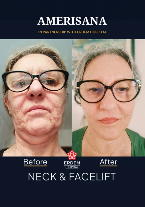 Neck & facelift before and after, in partnership with Erdem Hospital